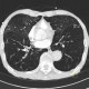 Bronchitis, panlobular emphysema: CT - Computed tomography